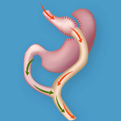 Cirugia de Banda Gástrica